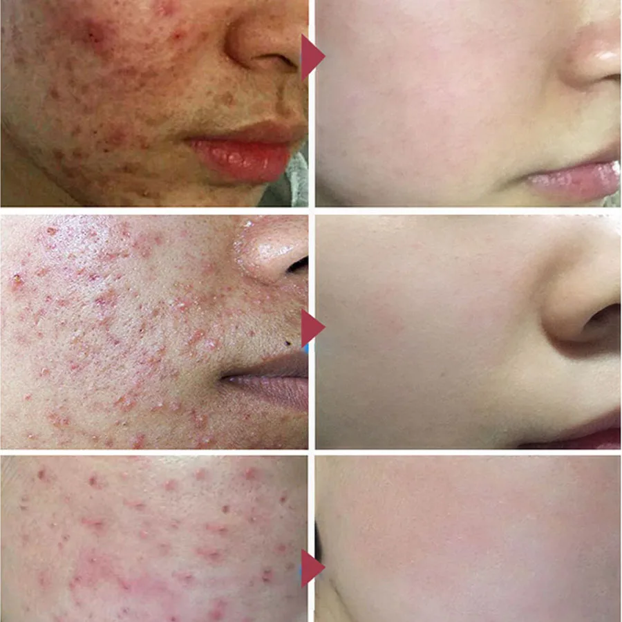 Эффективного удаления прыщей уход за кожей травяной крем анти для