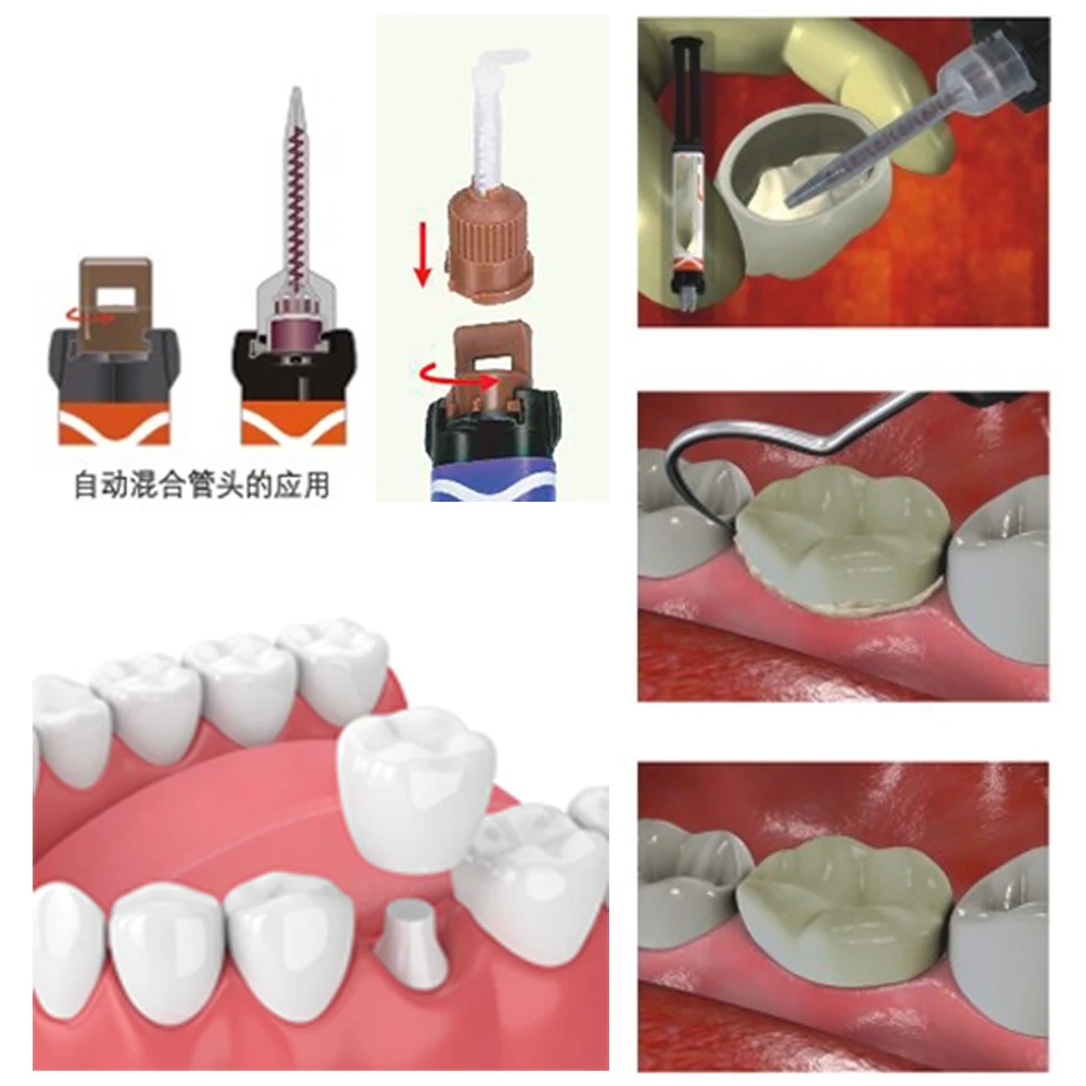 Стоматологический цементный клей для зубов корона временные клейкие материалы