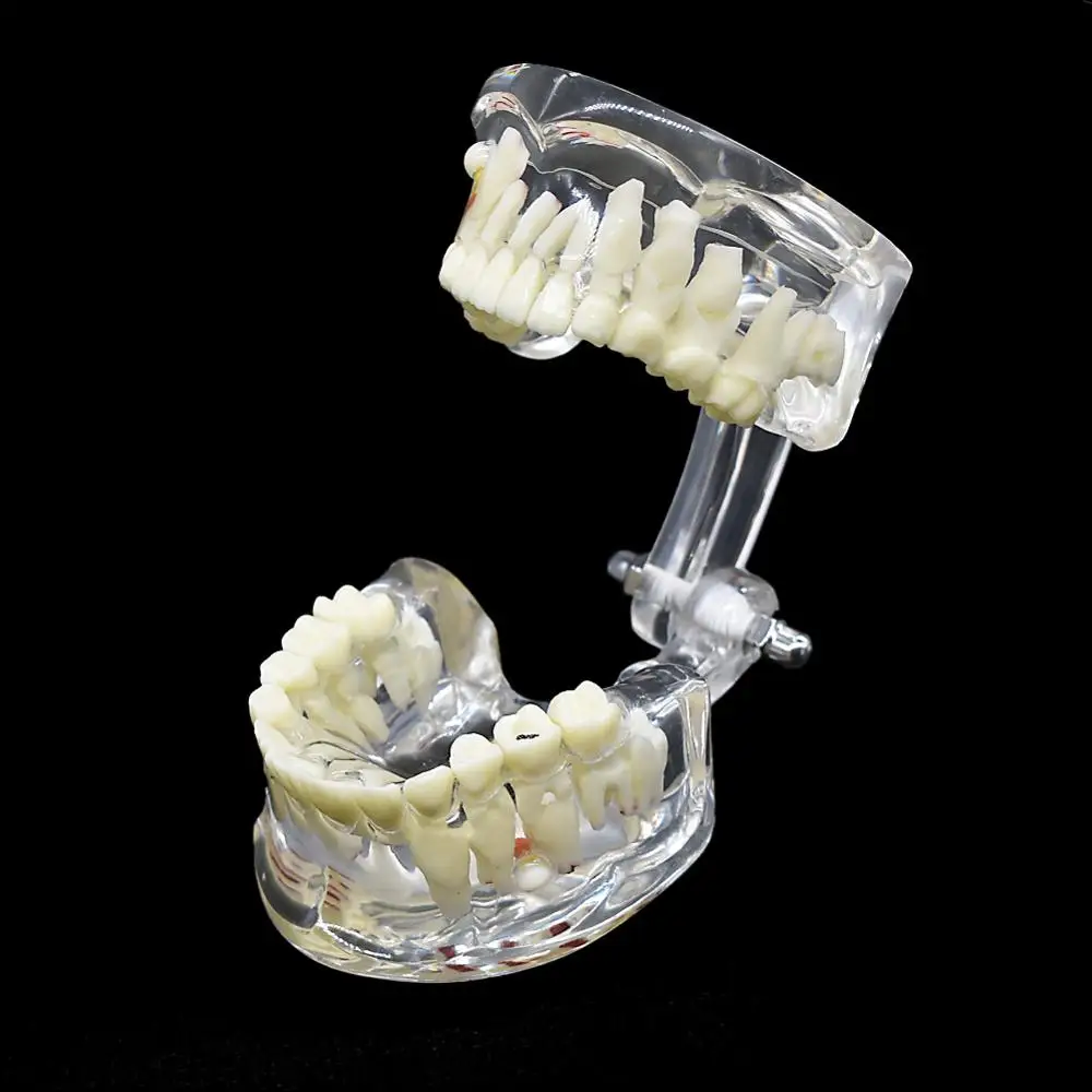 Стоматологическая детская модель патологических зубов Ортодонтическая для