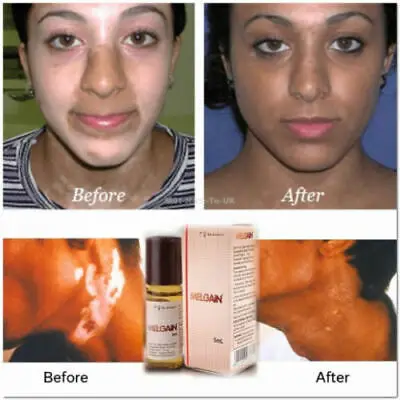 Бесплатная доставка лосьон для витилиго белые пятна патчи пигментация 5 мл| |