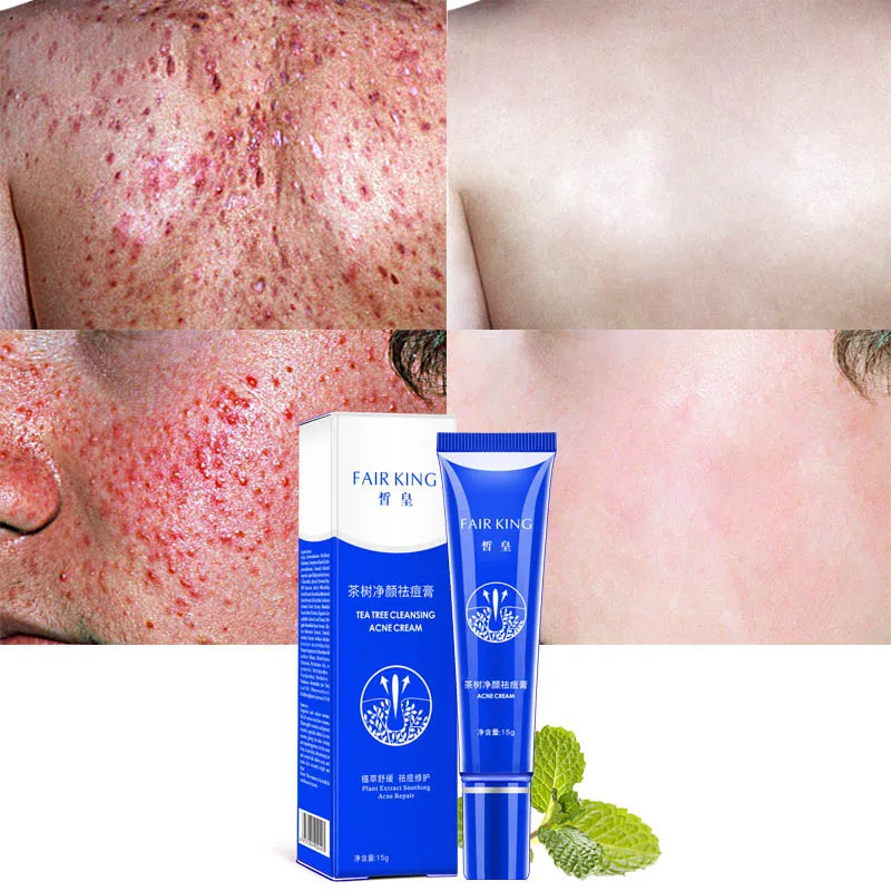 Tea Tree крем для очищения от акне кистозного быстрого действия лица тяжелой |