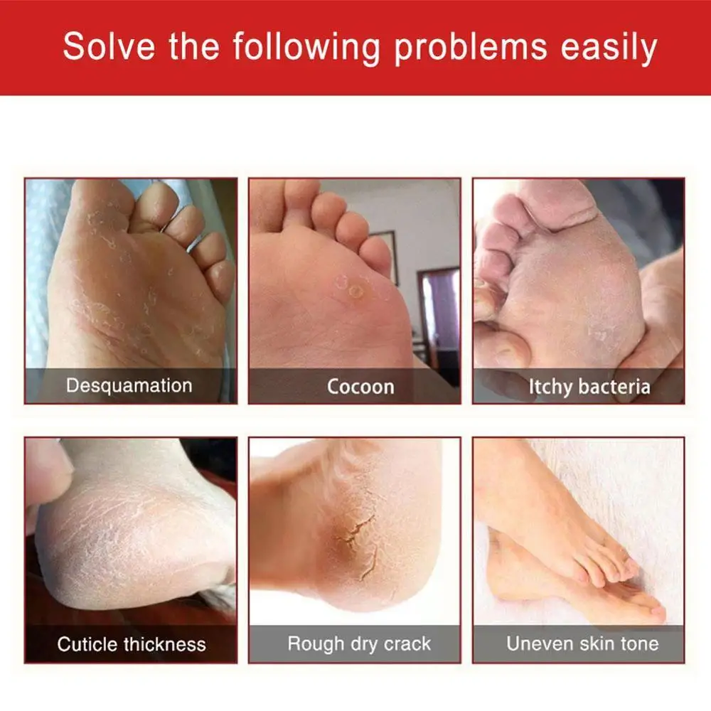 Крем для ног с конским маслом удаляет омертвевшую кожу и питает ногу против