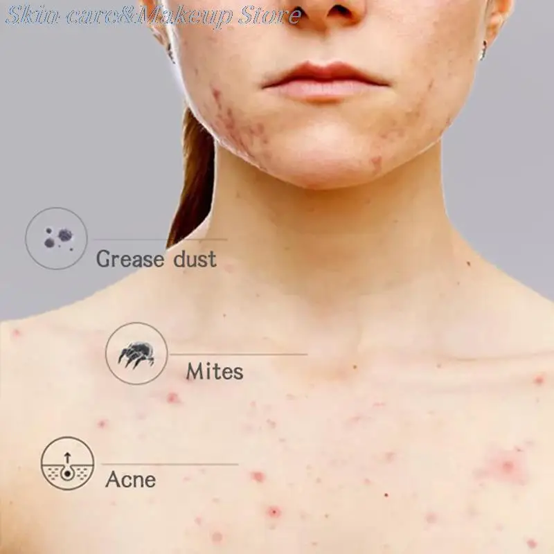 Африканское черное мыло Magic для акне сухой кожи появления удаления шрамов