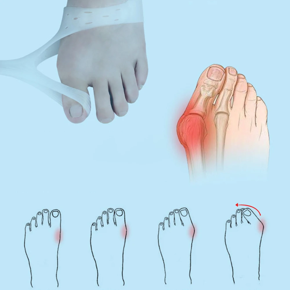 

1Pair Silicone Gel Thumb Corrector Insoles Toe Separator Toe Overlapping Pain Relieve Spreader Foot Protector Relief Pads