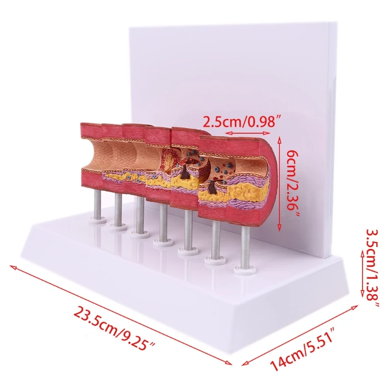 

Human Atherosclerosis Model Artery Pathology Anatomical Blood Vessel Anatomy Thrombus Blood Fat