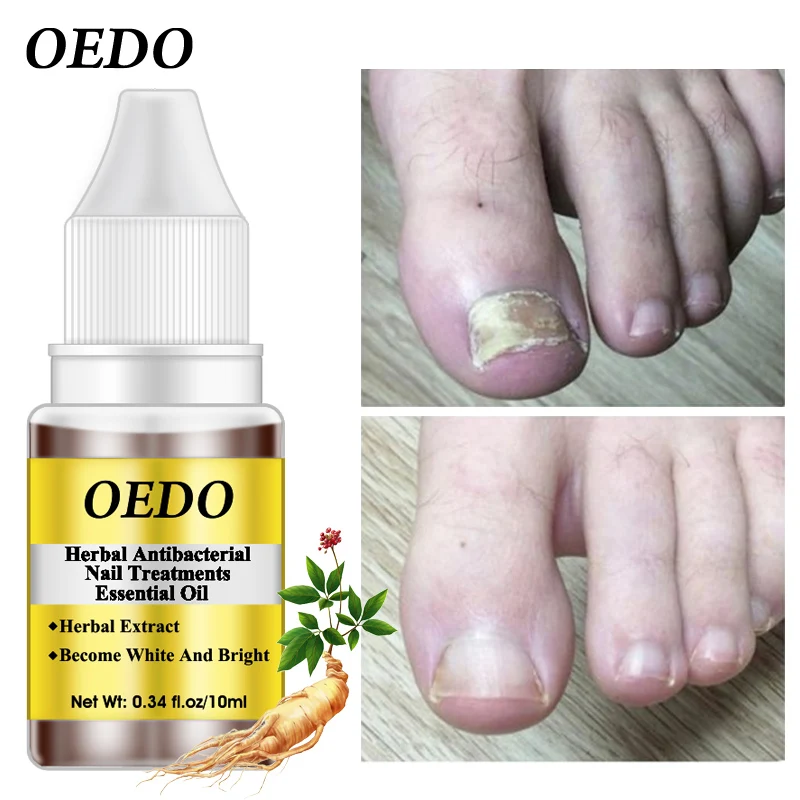 

Herbal Antibacterial Nail Treatments Essential Oil Herbal Extract Nail Fungus Art Repair Tools Foot Nail Care Repair Serum