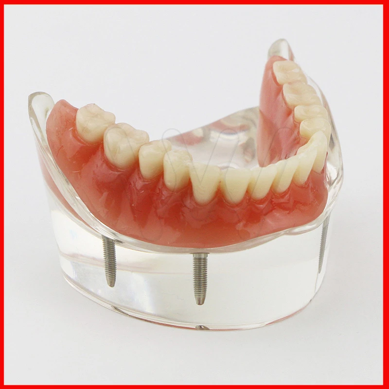 1 .     Overdenture  4