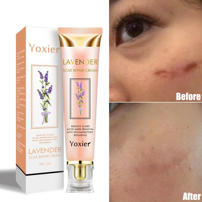 1 шт. 20 г восстанавливающий крем для шрамов Удаление прыщей растяжек корректор