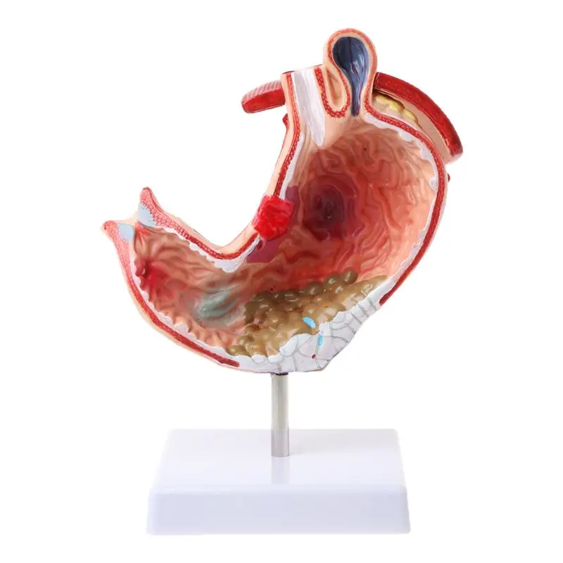 

H05B Human Anatomical Anatomy Stomach Medical Model Gastric Pathology Gastritis Ulcer Medical Teaching Learning Tool