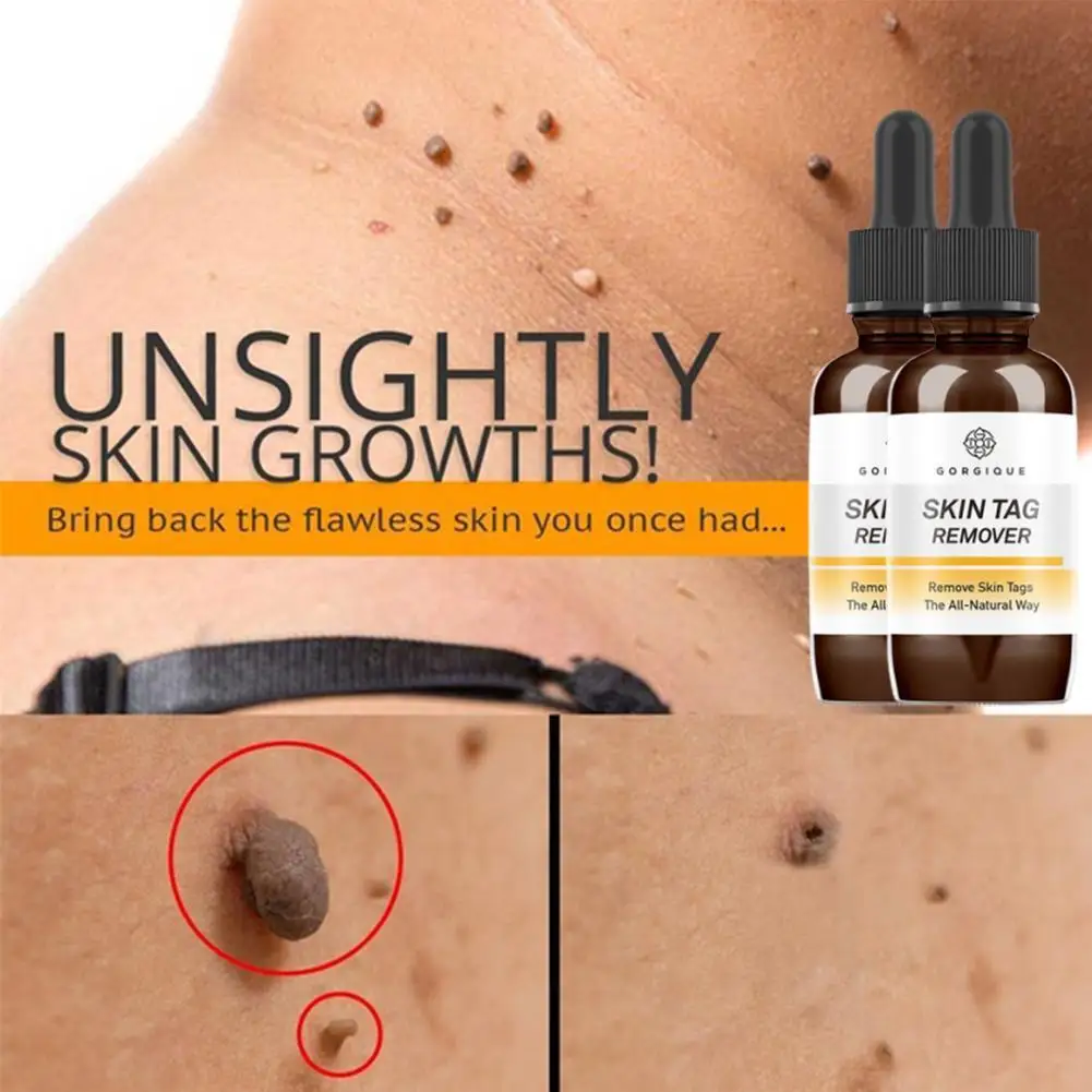 

1pcs 10ml / 20ml / 30ml Mole Remover Corn Warts Foot Marking Lotion Wart Eliminating Essence Smooth Skin Care