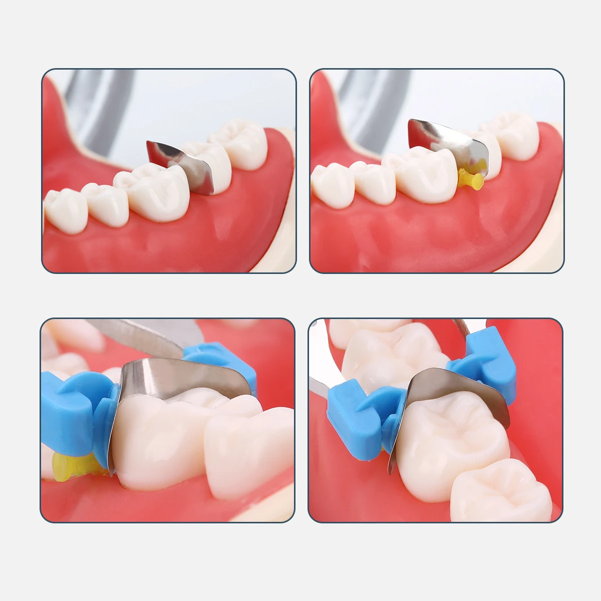 AZDENT стоматологический секционный контурный металлический матричный стержень 30