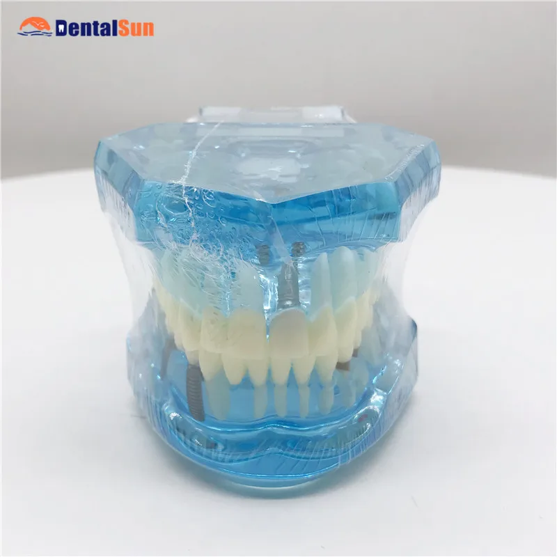 

Dental Teeth Model M2001 Implant and Restoration Model