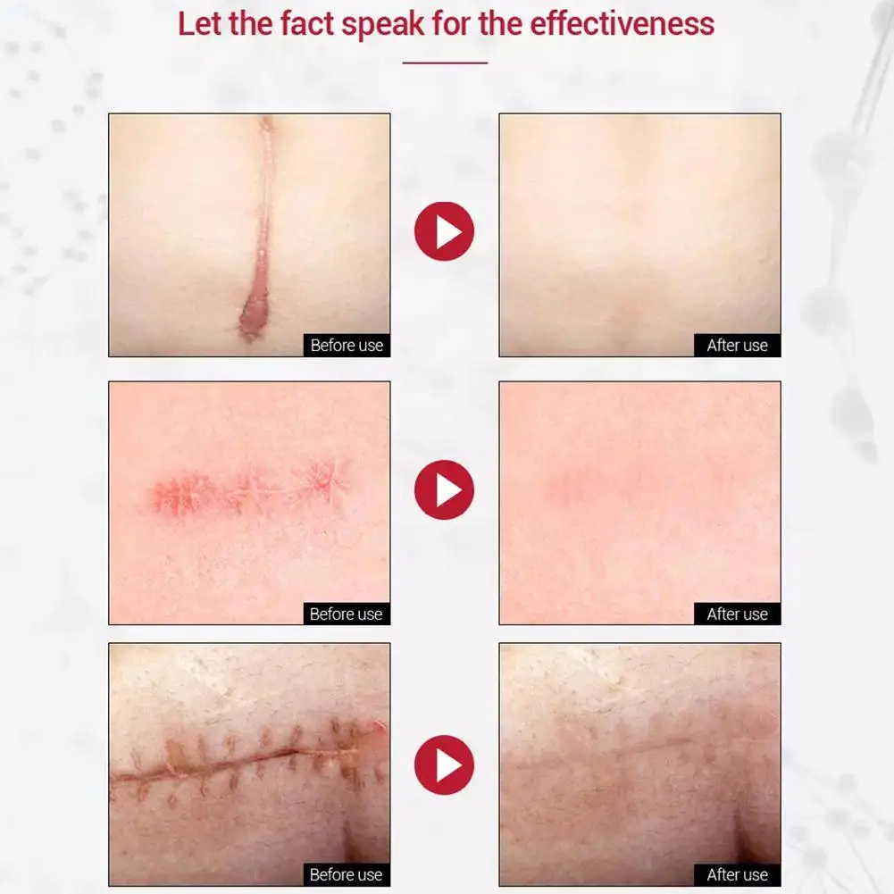 

Scar Repair Serum Pregnant Stretch Marks Remover Essence Acne Effective Treatment Fade Fine Line Whitening Liquid Skin Care 20ml