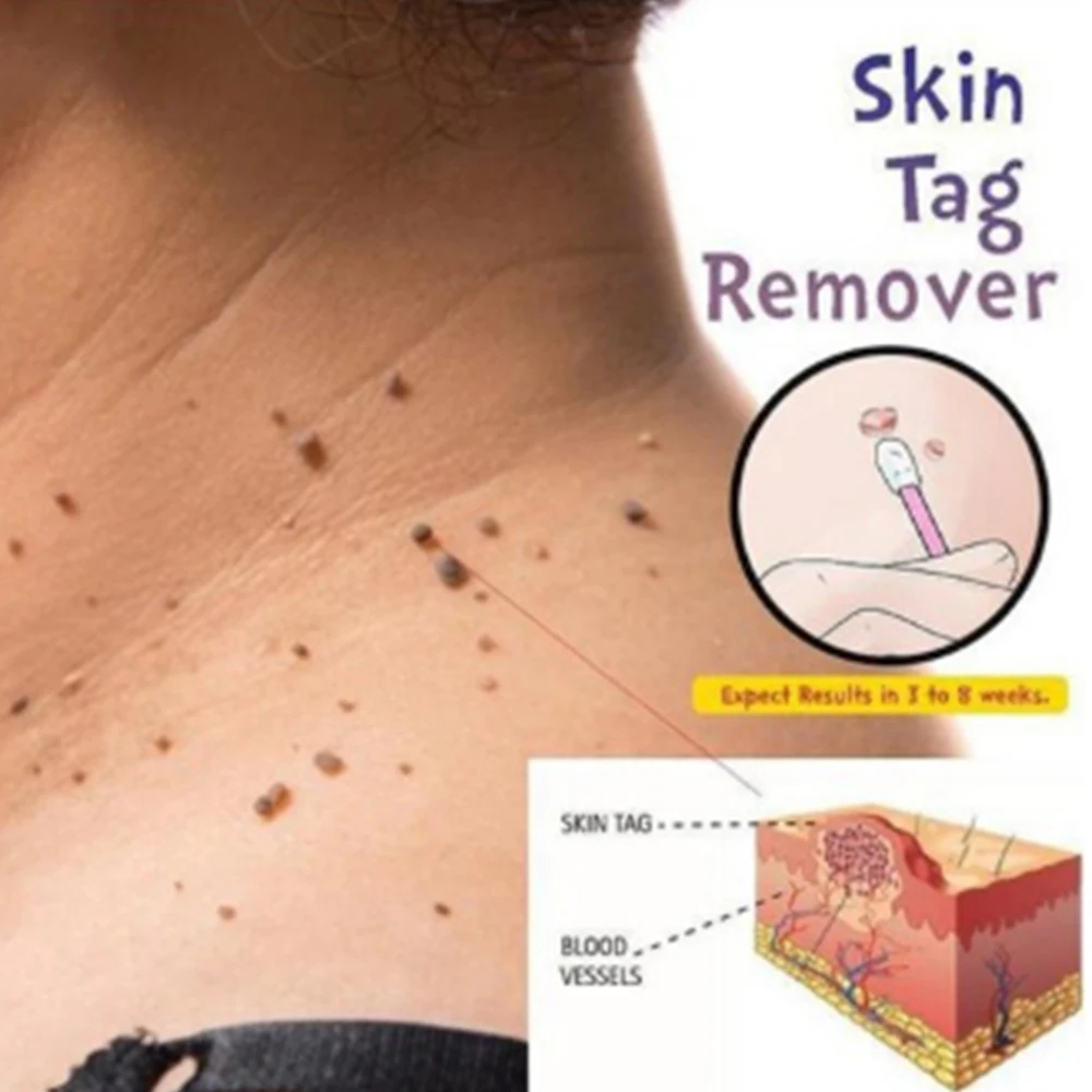 3ml Ultra Strength Skin Tag Remover Pen Repair Medical Kill Foot Corn Mole & Genital Wart D438 | Красота и здоровье