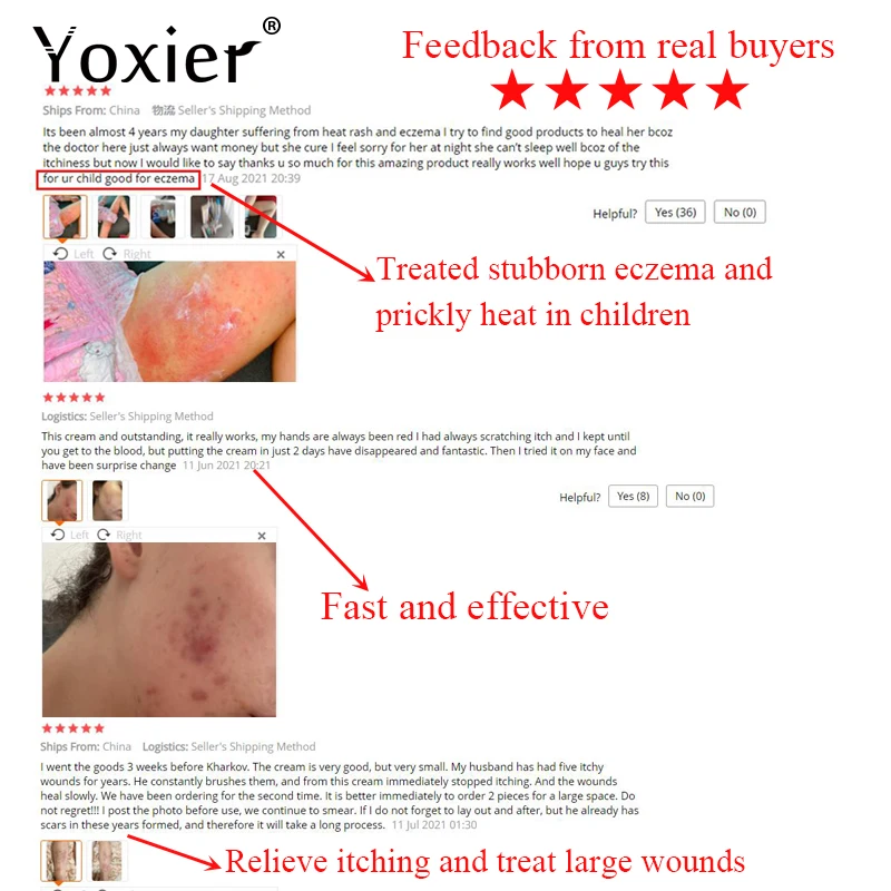 3 шт. антибактериальный крем Yoxier для лечения экземы |