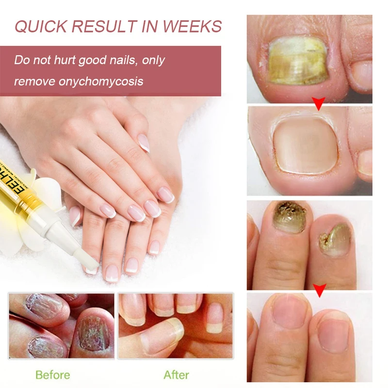 1/2 шт. антигрибковая жидкость для ногтей | Красота и здоровье