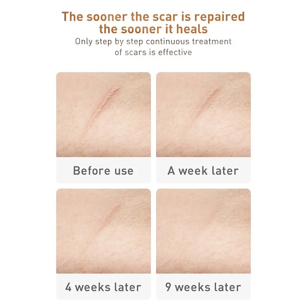 

30g Scar Cream Acne Scar Removal Repair Cream Skin Care Products for Women