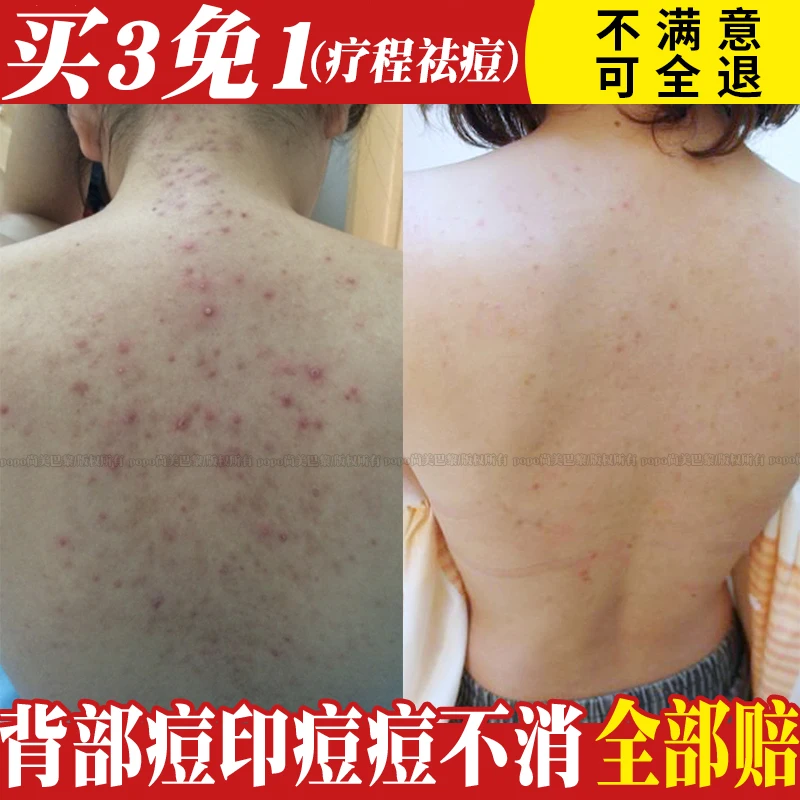 Уход за спиной эфирное масло от акне удаление шрамов и пятен уход кожей