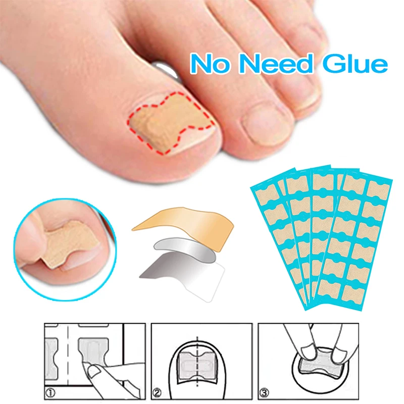 

Ingrown Toenails Correction Patch Physical Straightening Elastic Toenail Pedicure Stickers Brace Bunion Corrector Self Adhesive