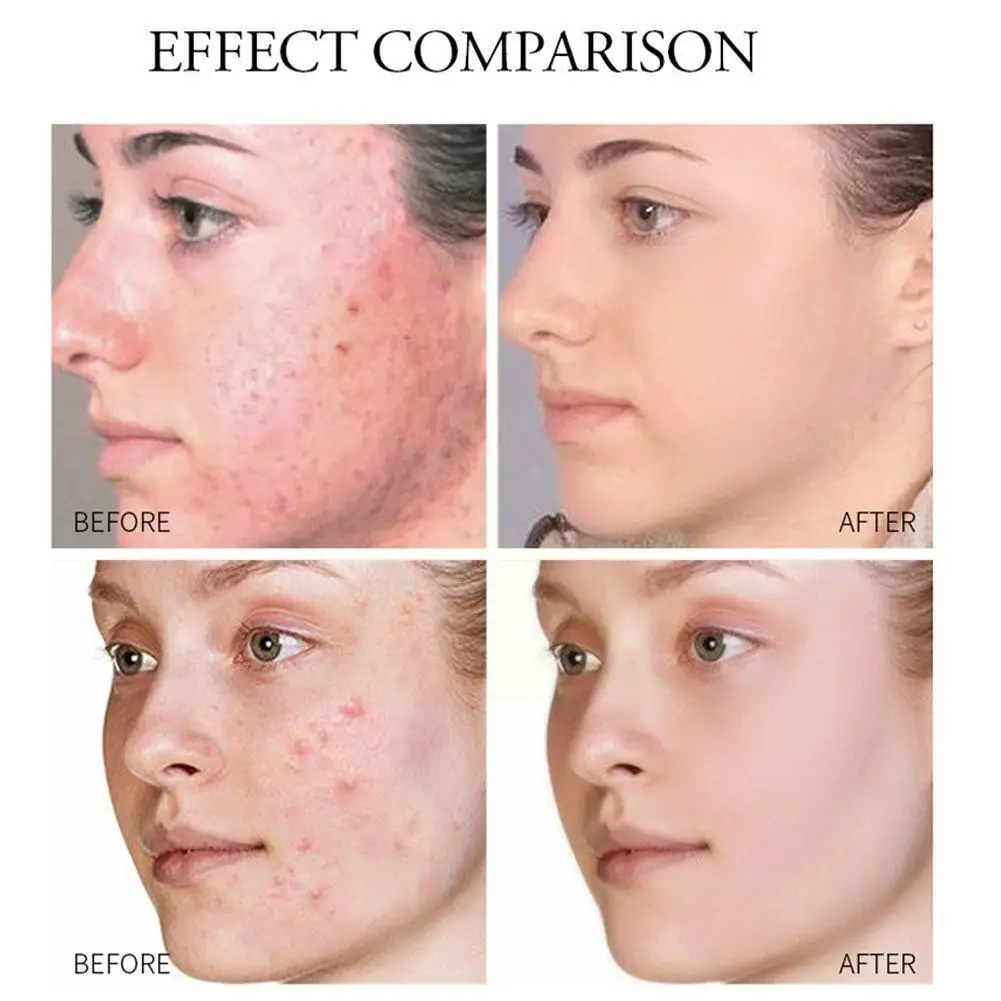 Угревой сыпи травяной крем для чистки ремонт акне косточки пор против уход