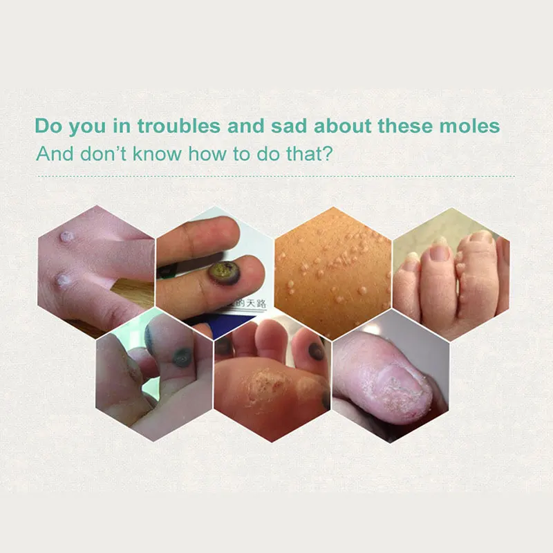 10 мл антибактериальные средства для ног удаляют бородавки омертвевшей кожи