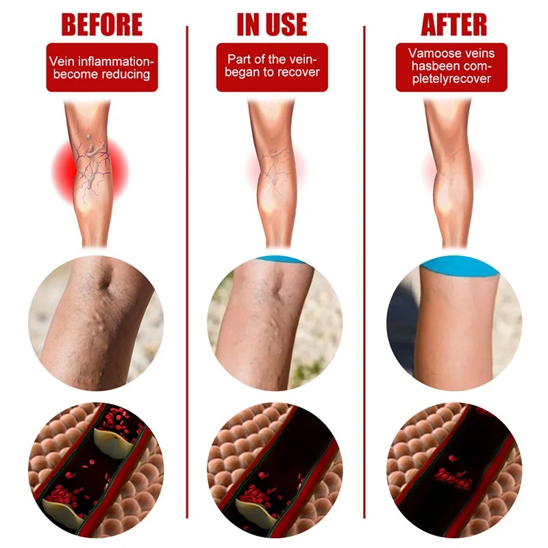 Пластырь для лечения варикозного расширения вен 6 шт./пакет | Красота и здоровье