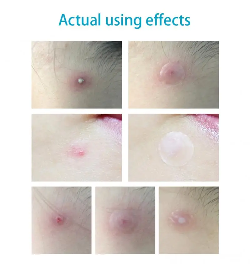 Эффективные пластыри от прыщиков 25 шт. незаметные Пластыри для ухода за пятнами