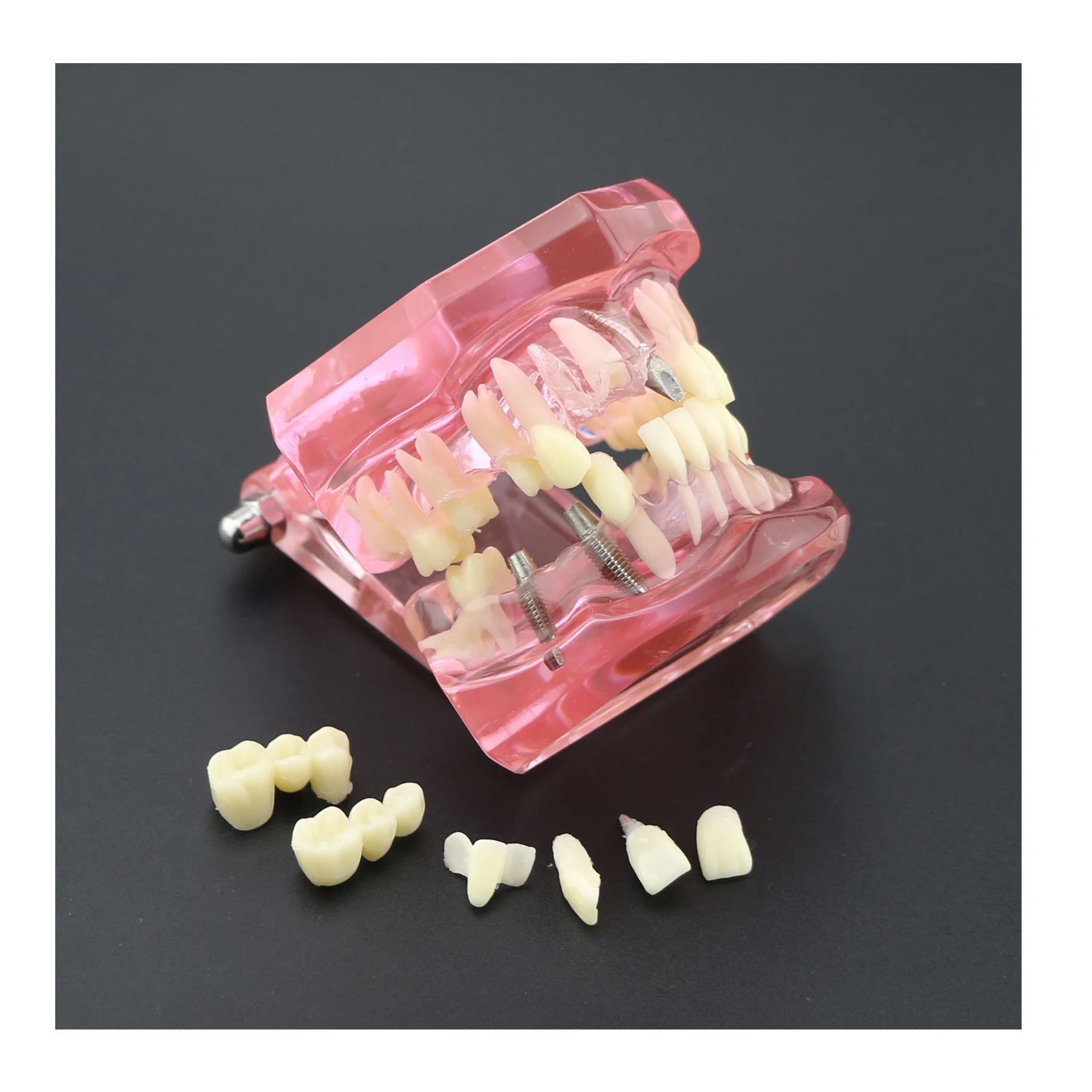 

Dental Teeth Model Implant Study Analysis Demonstration With Restoration Pink