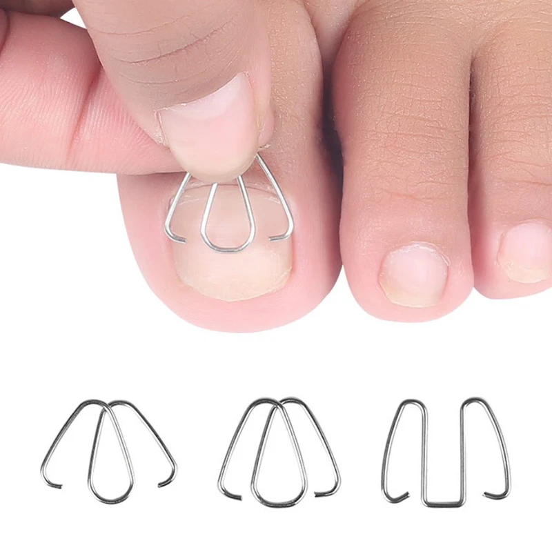 

Toenail Nail Ingrown Clip Orthosis Paronychia Pedicure Foot Tool Corrector Nail Art Ingrown Toe Nail Correction Tool