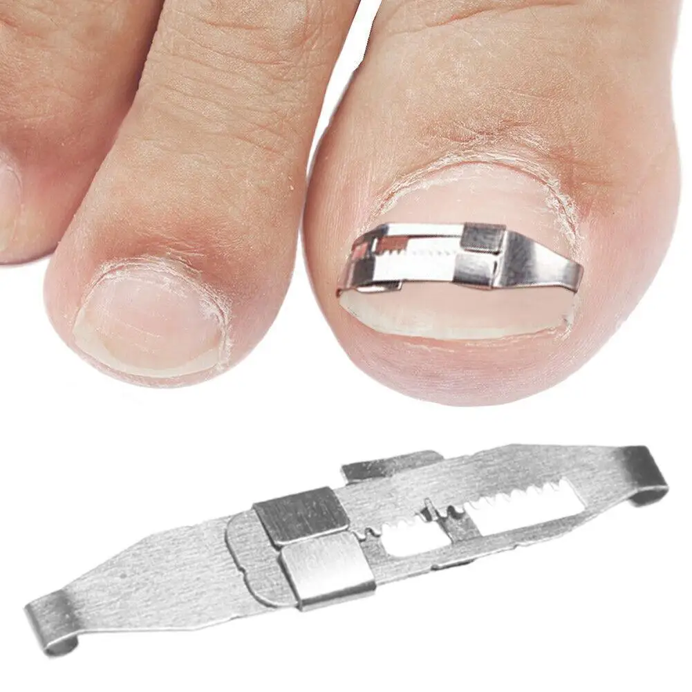 

1 пара вросших ногтей коррекция фиксатор для ногтя добавьте ногти для ног "францзуский маникюр" Педикюр Уход коррекции стопы инструмент под...