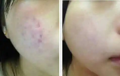 Рисунок 4 - Набор сушеных в замораживании порошков