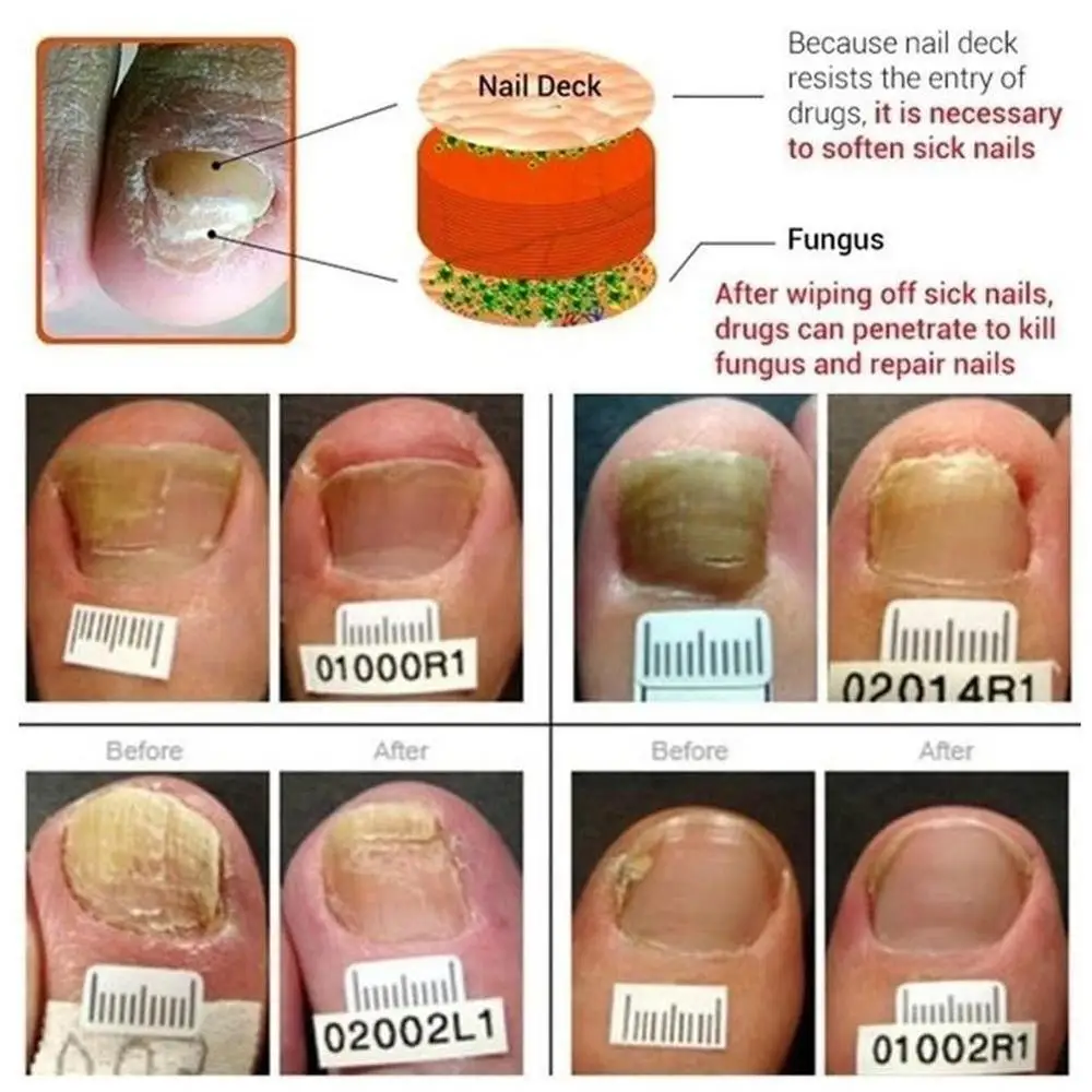 Противогрибковый набор для домашнего лечения ручка Ногтей онихомикоз пароникья