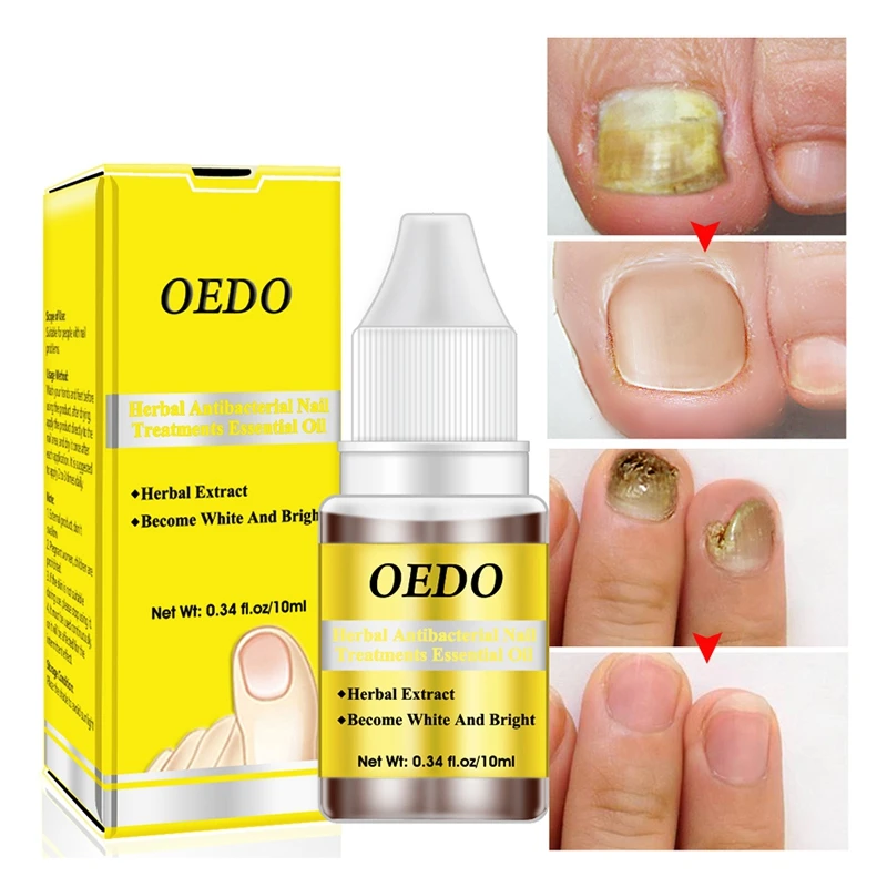 

Oedo herbal Antibacterial Nail Treatments Essential Oil Herbal Extract Nail Fungus Art Repair Tools Foot Nail Care Improve Infec