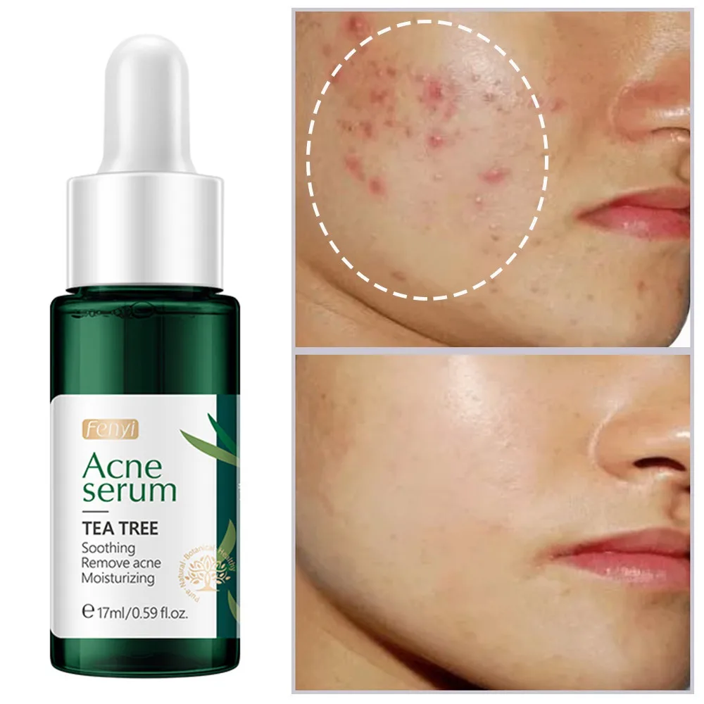 

Tea Tree Acne Treatment Face Serum Anti Acne Whelk Oil Control Shrink Pores Essence Moisturizing Whitening Repair Pimple Scar