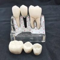 dental implant model 4 times analysis crown bridge demonstration dentist teaching resources dentistry clinic training tools