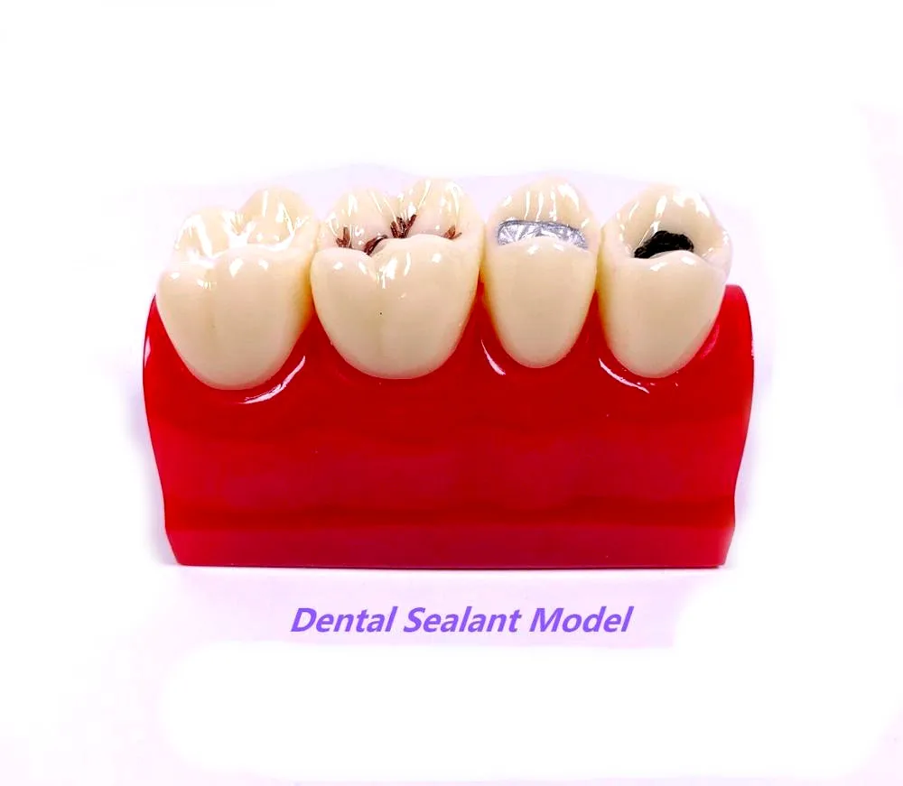 1pcs Dental Pit Fissure Caries Sealant Study Model Silver Amalgam Teach Study