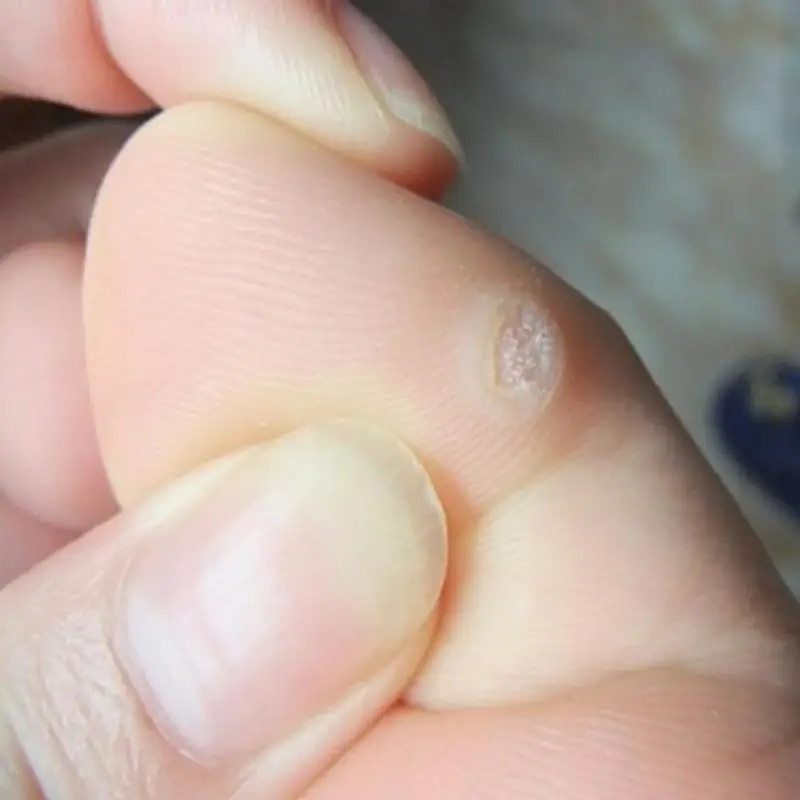 6 шт. ухаживает за кожей стоп наклейки медицинский пластырь удаления мозолей