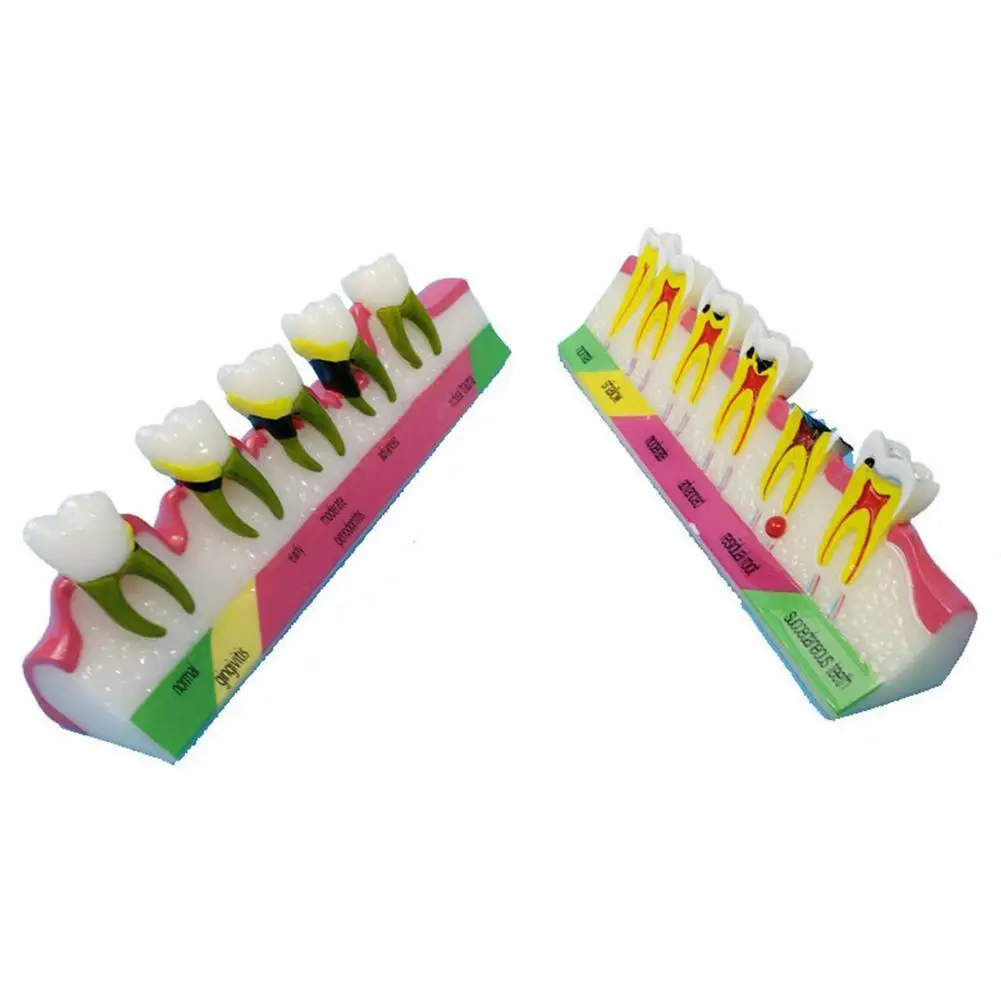 

Teeth Periodontal Disease Model Dental Caries breakdown display Periodontitis show Teaching Tooth Model Dentist Communication