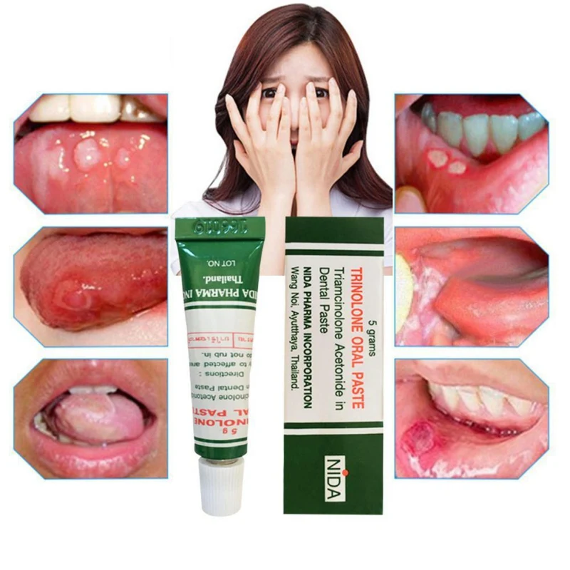 

100 PCS Anti-inflammatory Oral Ulcer Cream Effective Practical Pain Relieving Oral Ulcer Paste Oral Disinfection Treatment