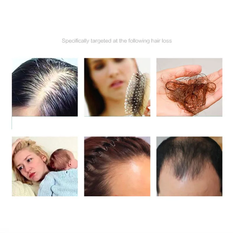 

Ginger Hair Growth Serum Oil Anti Hair Loss Tratamento Capilar Produtos De Cabelo Chute De Cheveux Caida del Cabello Hombre 30ML