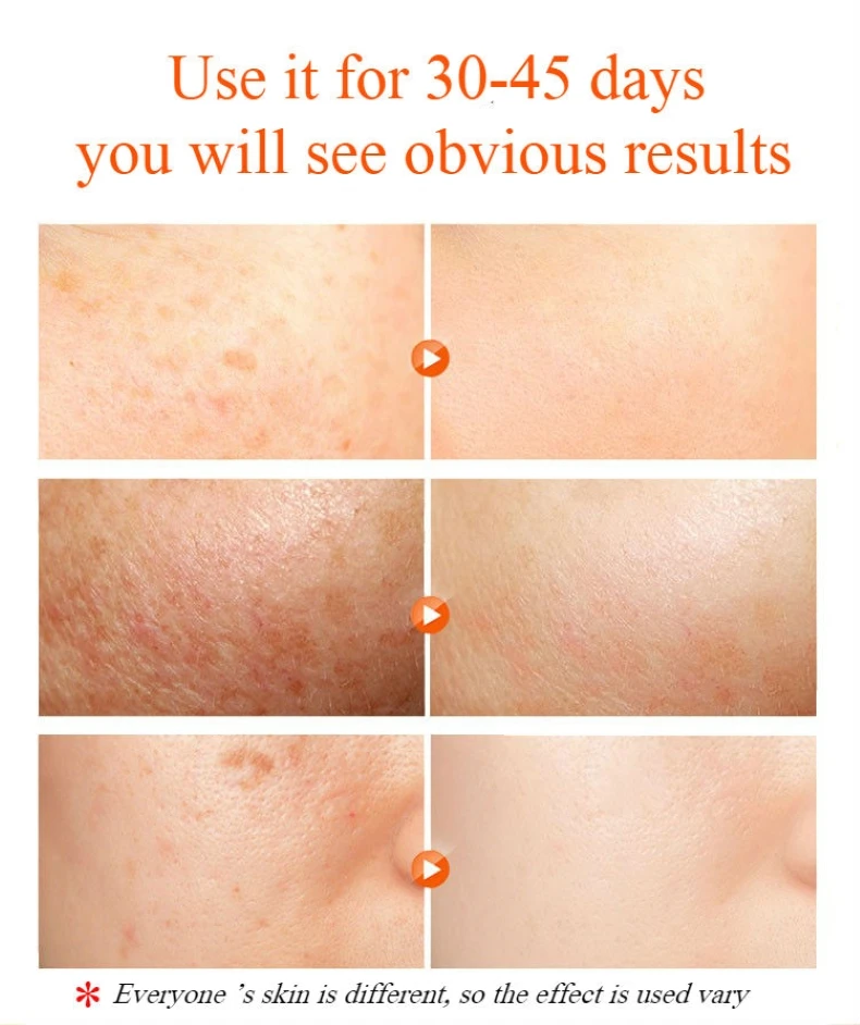 CHUMOLEE сильно отбеливающий крем для удаления мелазмы веснушки акне темные