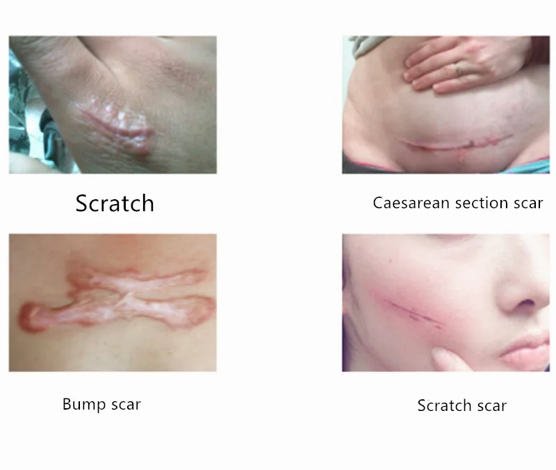 1 чехол из поликарбоната и силикона для удаления наклейка &quotшрам&quot 5x3 5 см