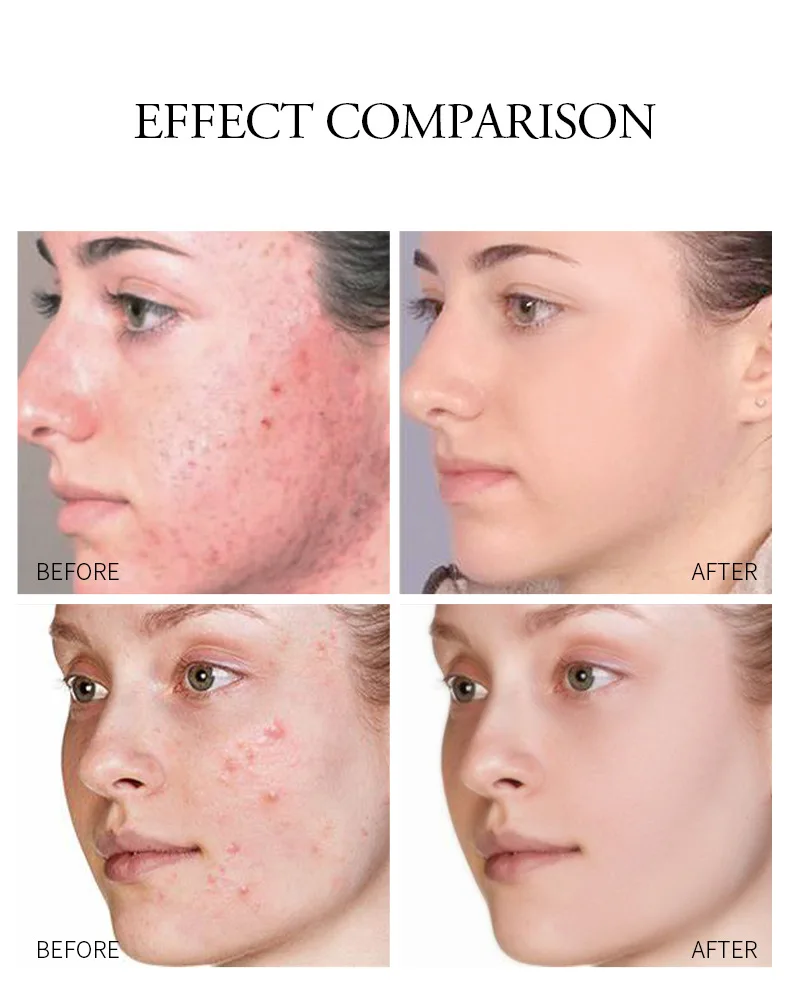 

Aloe Vera Gel Day Face Cream Skin Care Hyaluronic Deep Hydration Acid Moisturizing Acne Treatment Cream Korean Skin Care TSLM1