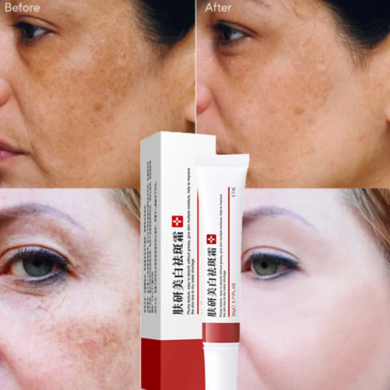 

Whitening Freckle Cream Remove Melasma Acne Spot Pigment Melanin Face Cream