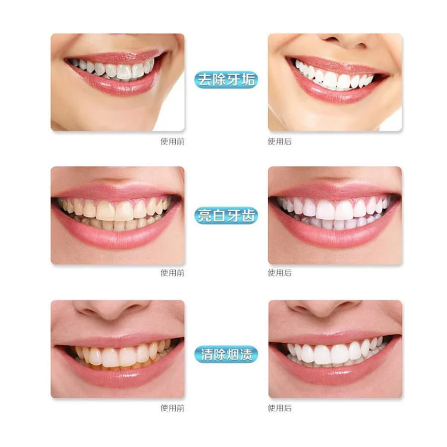 Стоматологическое оборудование стандартное отбеливание зубов 44% пероксидная