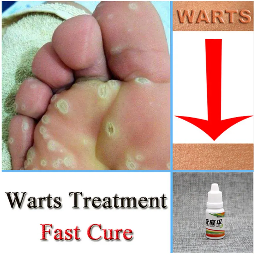 Chinese Medicine Treatment Foot Corn Removal Plantar Warts Pomada De Verruga Care Medical Plaster Ointment | Красота и здоровье
