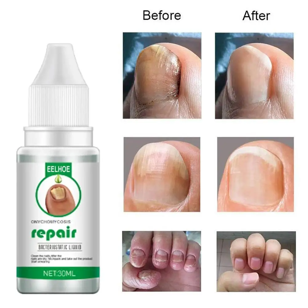 

Fungal Nail Treatment Serum Onychomycosis Paronychia Anti-Fungal Nail Infection Herbal Toe Fungus Foot Repair Essence 10ml-30ml