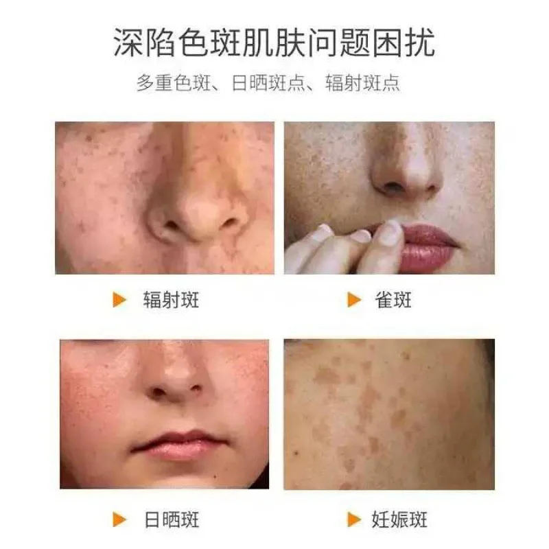 

Skin Discoloration Fade Cream Improve Skin Problem Brighten Skin Lightening Treatment Banishing Essence Freckle-Removing Cream