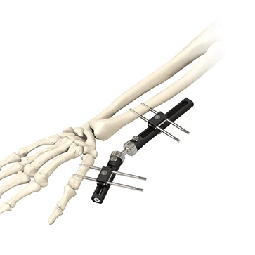 

Orthopedic PEEK wrist orthofix external fixation external fixator
