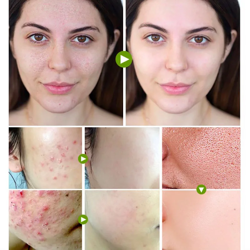 Крем для лица чайное дерево крем удаления шрамов от акне ухода за кожей